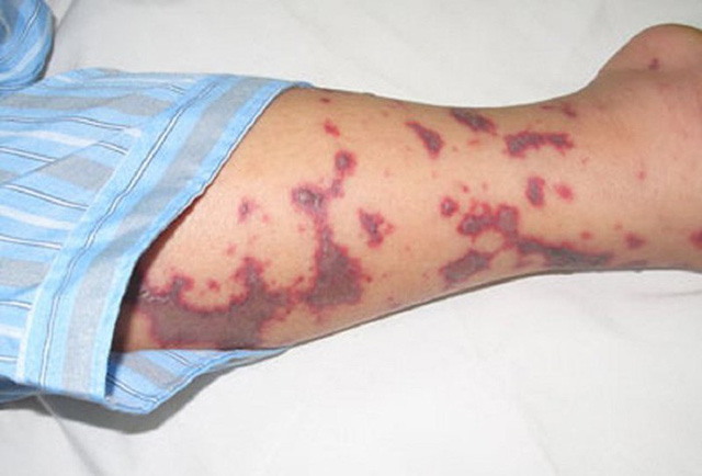 Viêm màng não mô cầu - Hình ảnh minh họa